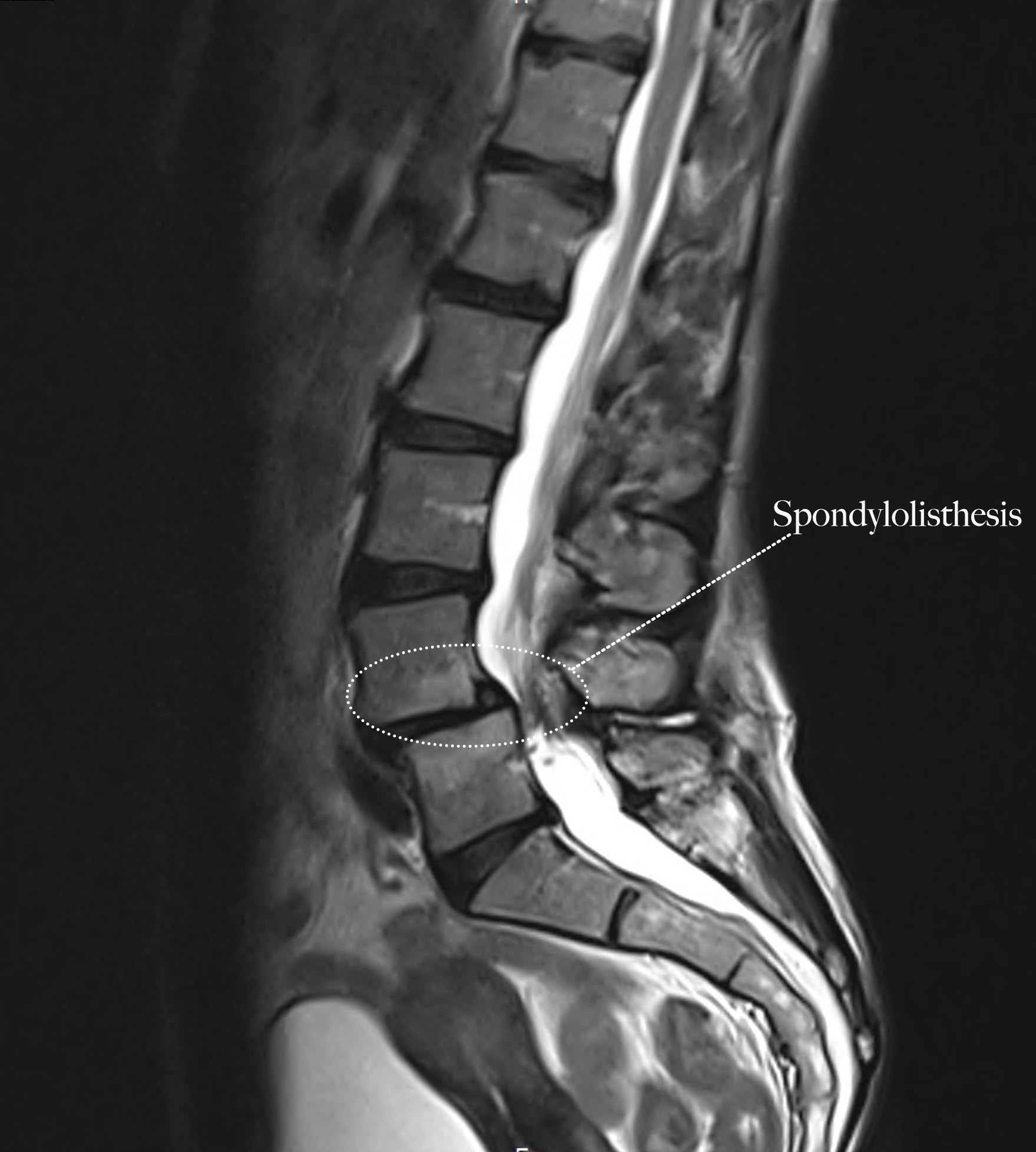 Surgery for Spondylolisthesis