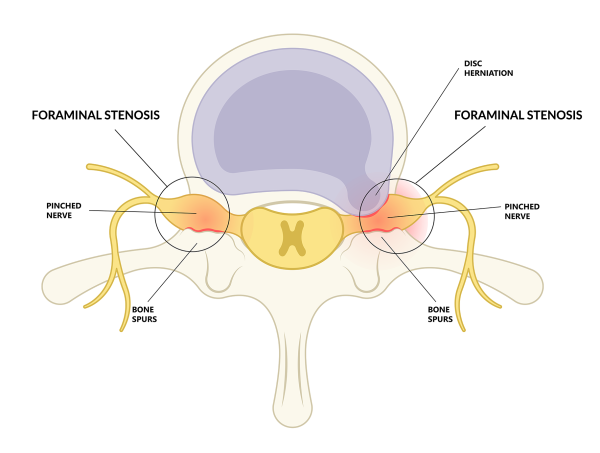 Spinal Canal Stenosis Treatment, Symptoms & Causes