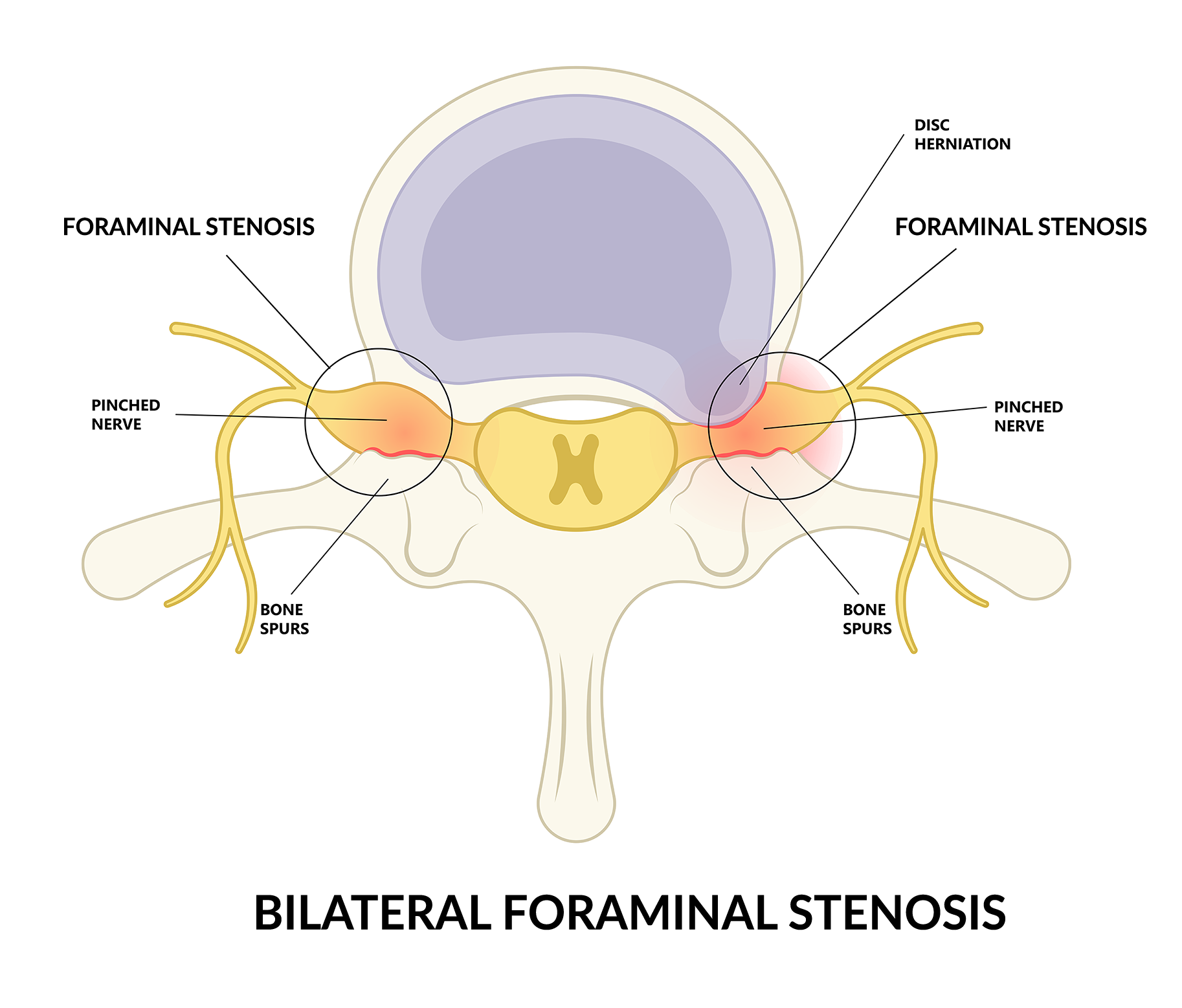moderate bilateral foraminal stenosis icd 10