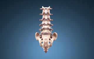 spinal implants