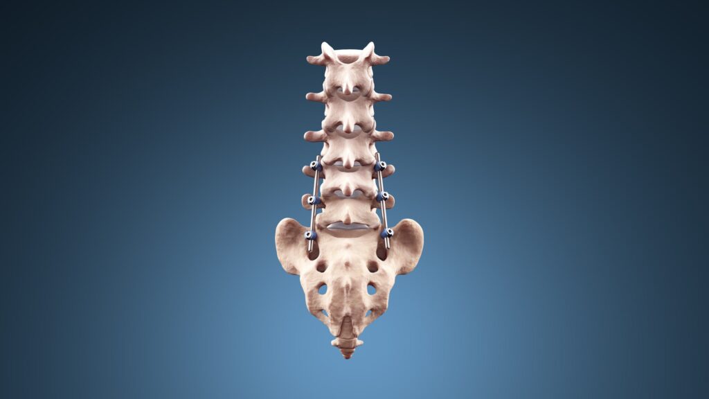 spinal implants