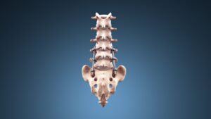 spinal implants