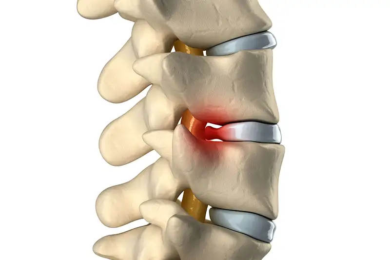 Disc_Herniated 5