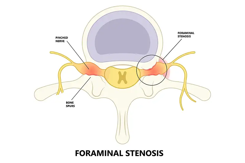 Foraminal_Stenosis_Body 1