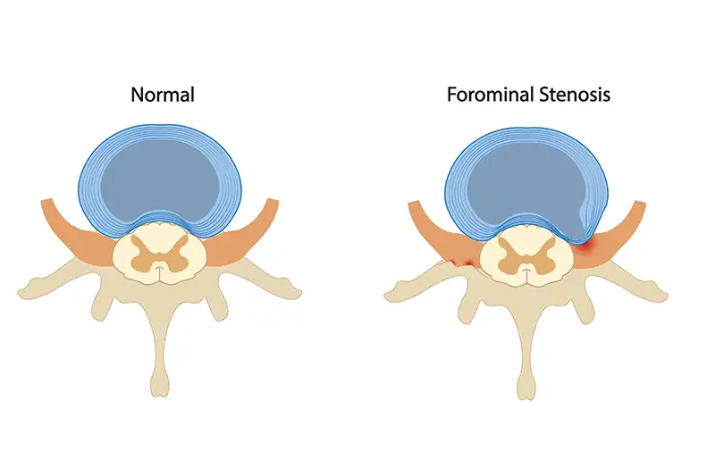 Foraminal_Stenosis_Body_2