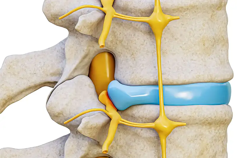 Herniated_Disc 6