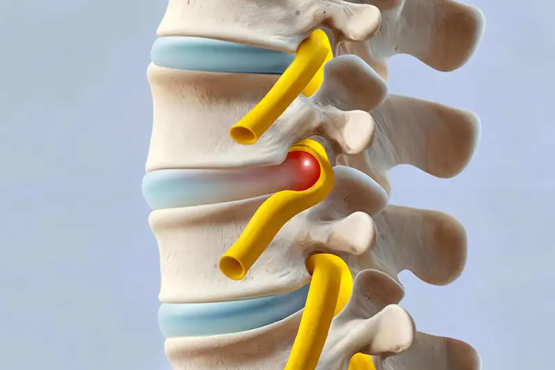 Herniated_Disc 7