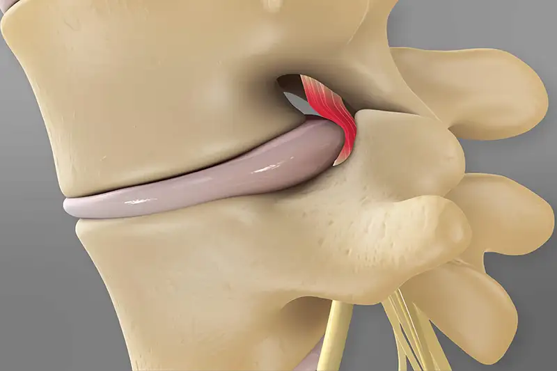Herniated_Disc 8
