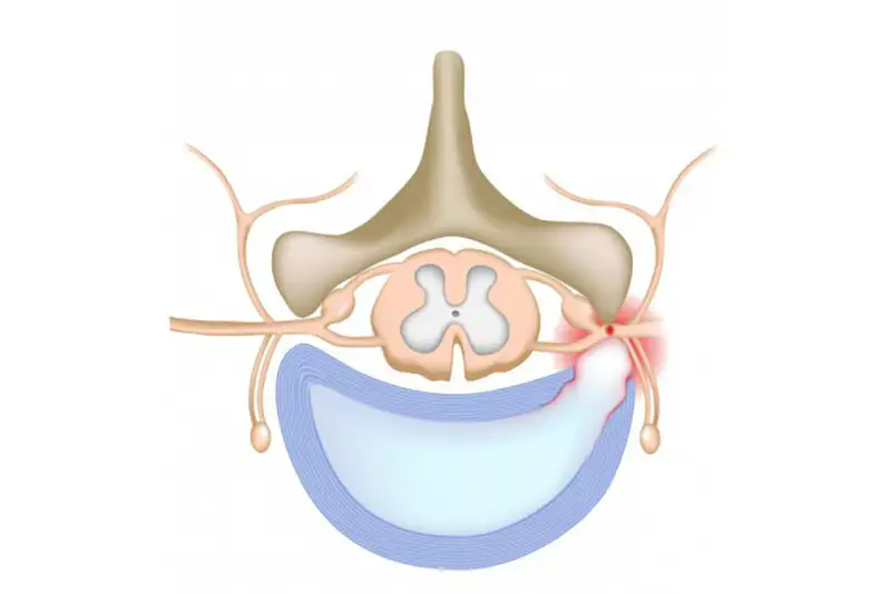 Illustration of a Ruptured Disc and a Normal Disc in Hudson & Tampa, FL