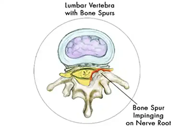 Illustration of Pinched Nerve Causes in Hudson & Tampa, FL