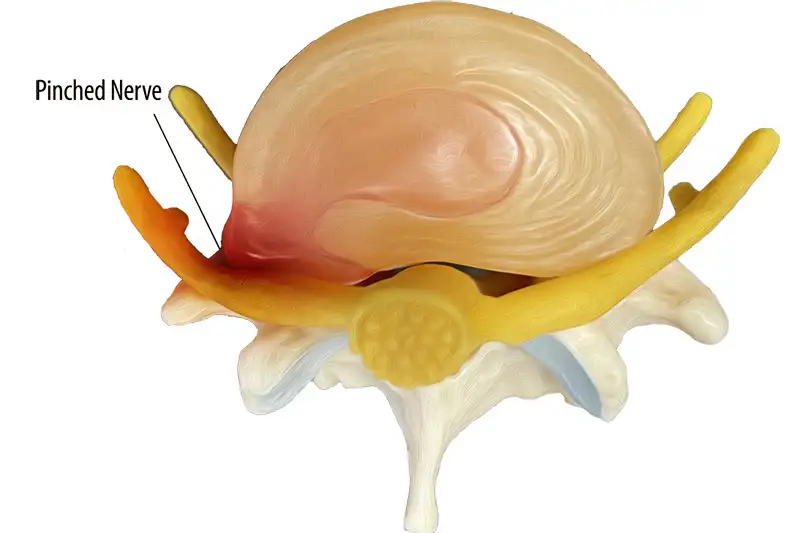 Pinched Nerve Pain in Hudson & Tampa, FL