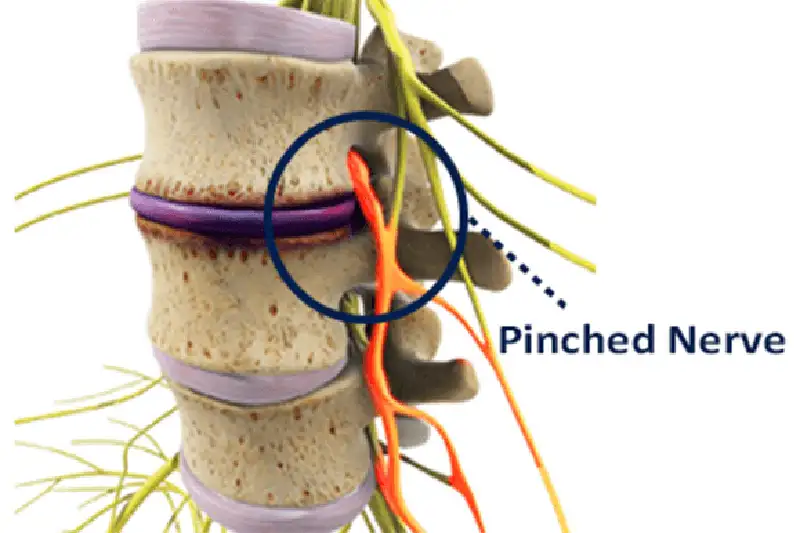 Illustration of Pinched Nerve Treatment in Hudson & Tampa, FL