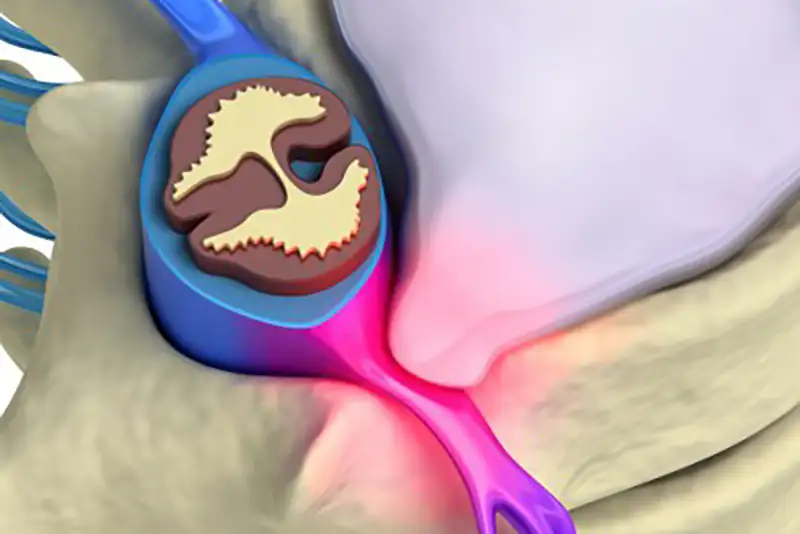 Prolapsed Disc Treatment in Hudson & Tampa, FL