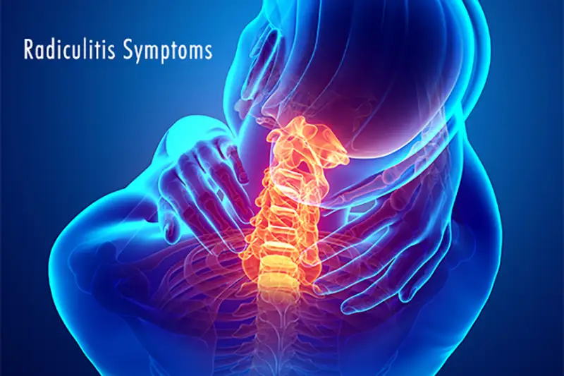 Radiculitis Symptoms in Tampa FL