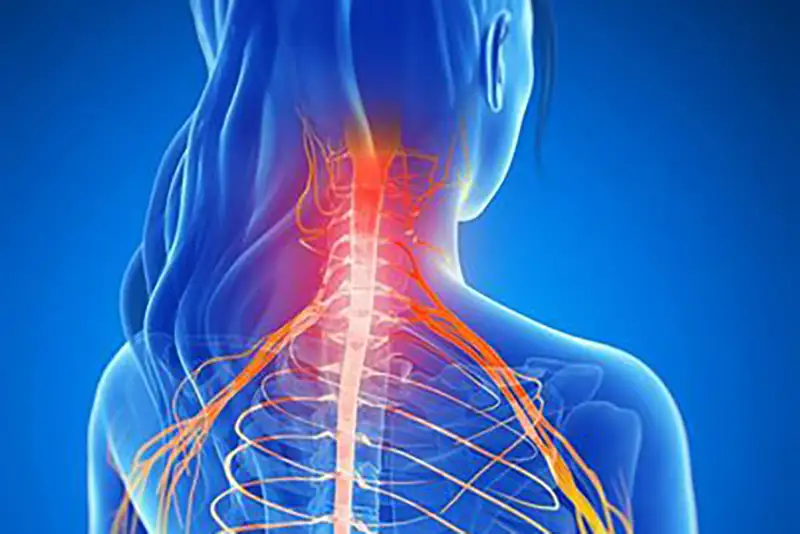 Radiculopathy Care in Hudson & Tampa, FL