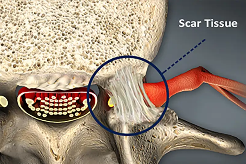 Scar Tissue Removal Surgery in Tampa area