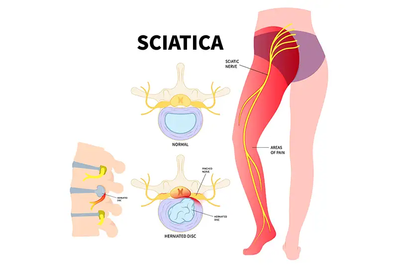 Sciatica 2