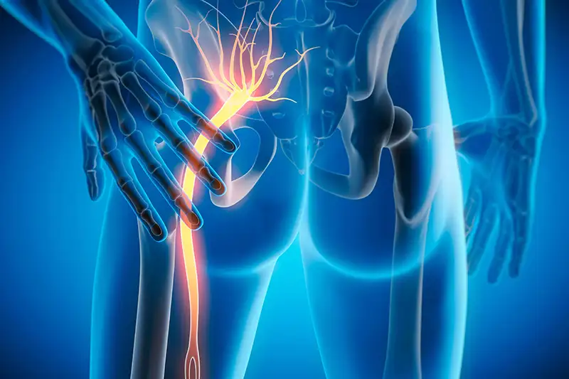 Sciatica 4