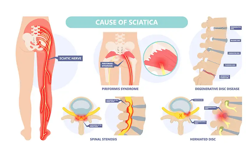 Sciatica_Causes 1