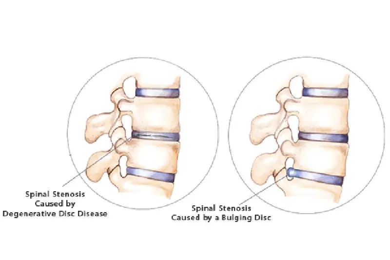 Illustration of Spinal Stenosis Causes in Hudson & Tampa, FL