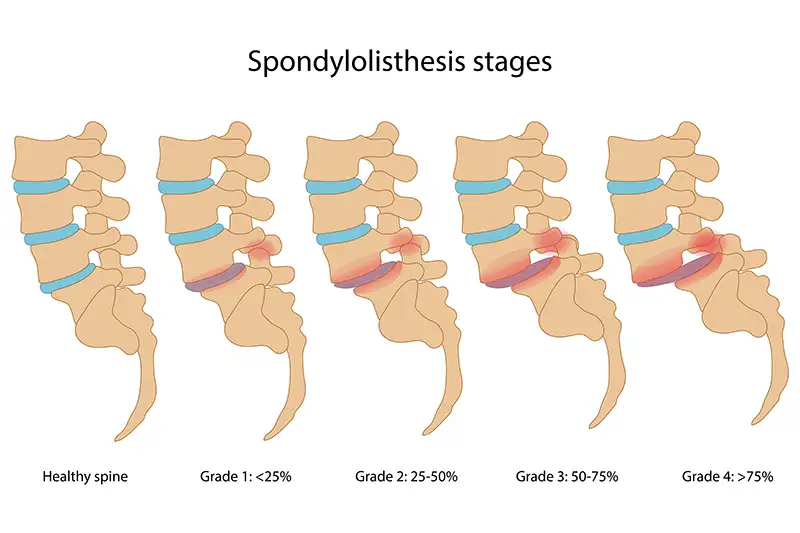 Spondylolisthesis 4