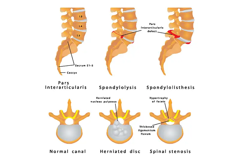 Spondylolisthesis 5