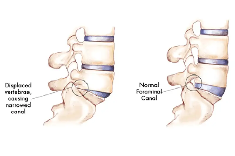 Spondylolisthesis Care in Hudson & Tampa, FL