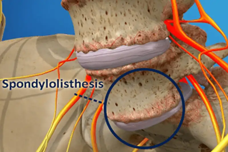 Illustration of Spondylolisthesis in Hudson & Tampa FL