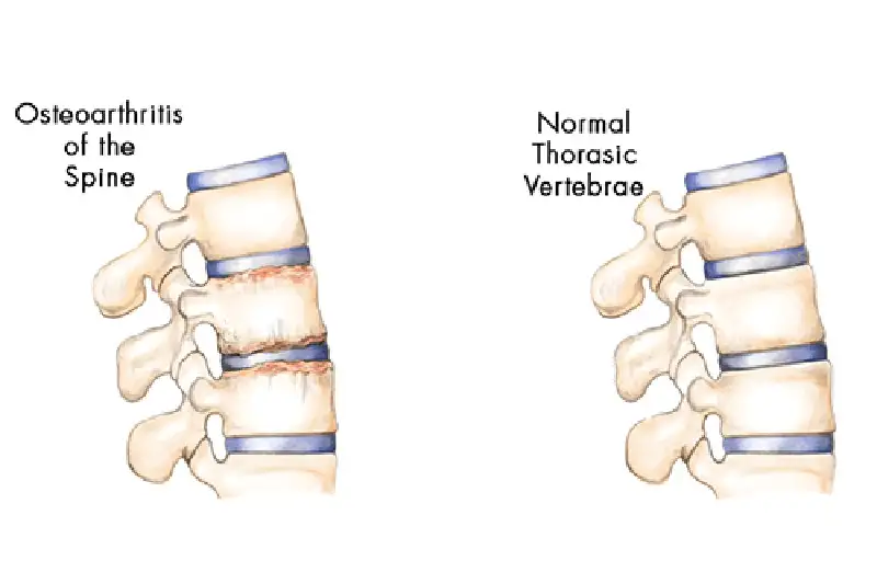 Spondylosis Causes in Hudson & Tampa, FL