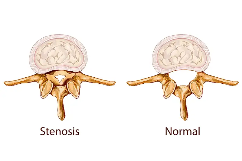 Stenosis 4