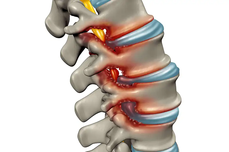 Stenosis