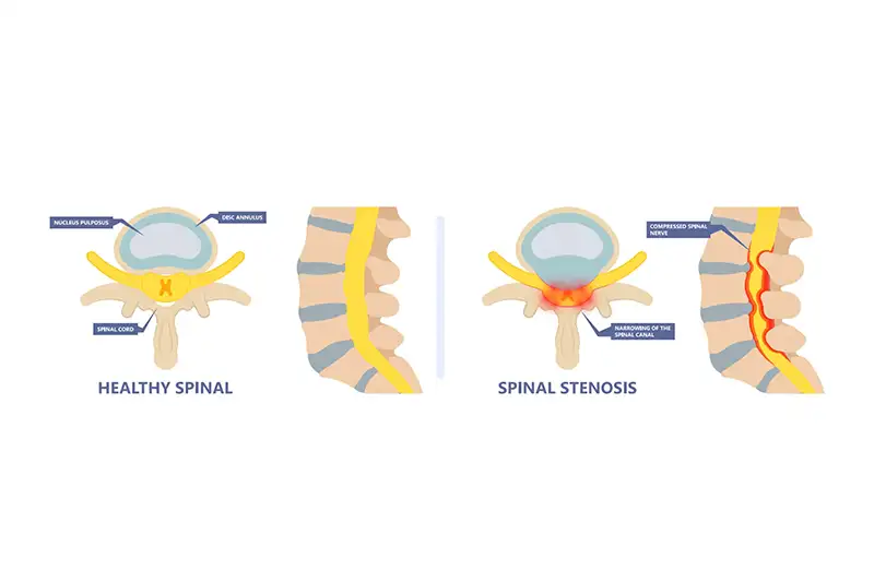 Stenosis_Body