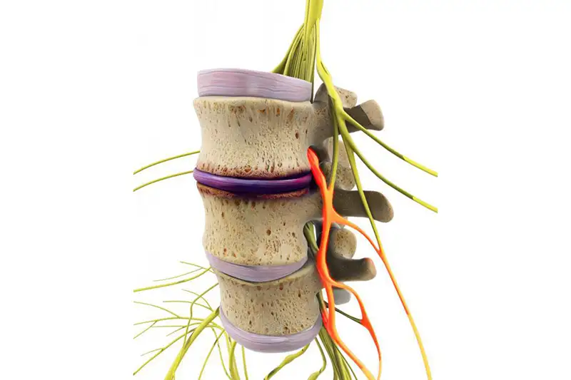 Illustration of Thoracic Spinal Stenosis in Hudson & Tampa, FL
