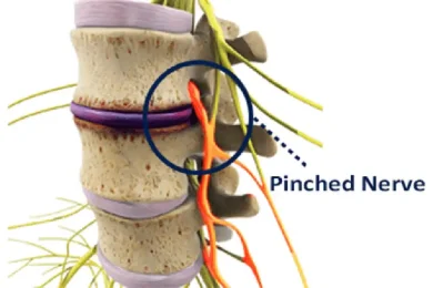 Illustration of Pinched Nerve Treatment in Hudson & Tampa, FL