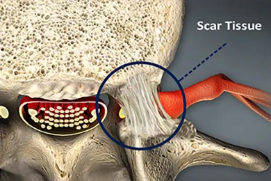 Scar Tissue Removal Surgery in Tampa area