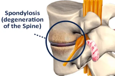 Spondylosis Treatment in Hudson & Tampa, FL