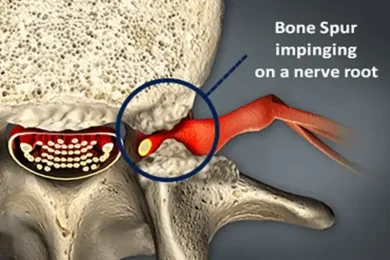 Treatment for Bone Spurs in Hudson & Tampa, FL