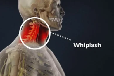 Whiplash Treatment in Tampa