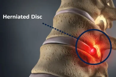 Herniated Disc Care in Hudson & Tampa Bay, FL,
