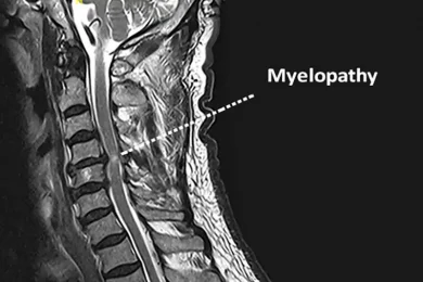 myelopathy